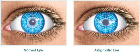 astigmatic-eye-illustration