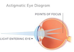 Astigmatism