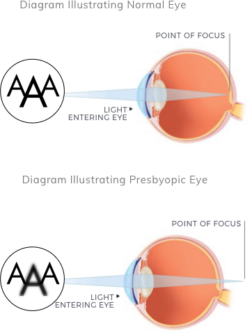 Age Related Long-sightedness (Presbyopia)