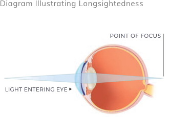 Long-sightedness (Hyperopia)