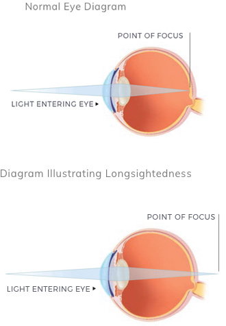 Causes of long-sightedness or Hyperopia