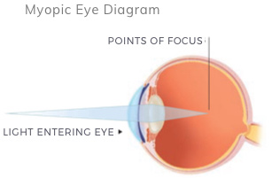 myopic-normal