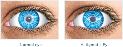 Astigmatic Eye Illustration
