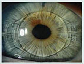 Phakic IOLs (ARTISAN Lens)