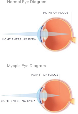 Causes of Short-sightedness (Myopia)