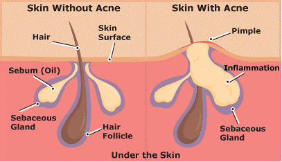 Acne sebaceous gland 