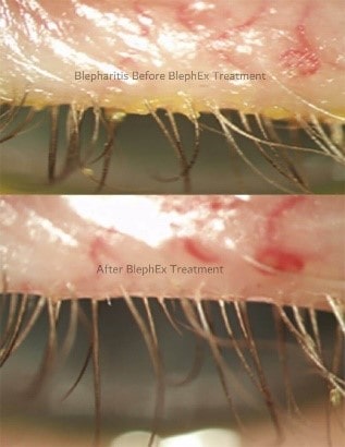 Blephex (In-House Lash Cleaning) - Dry Eye Treatment