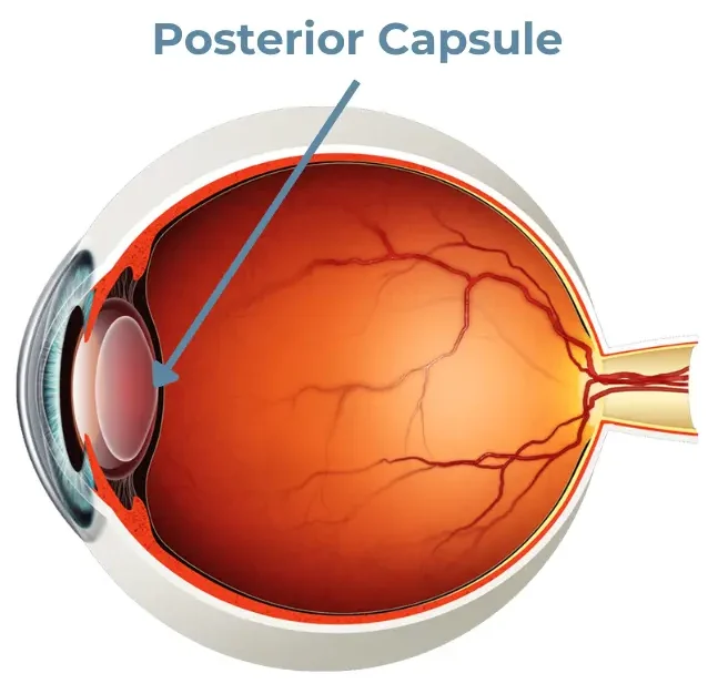 Posterior Lens Capsule