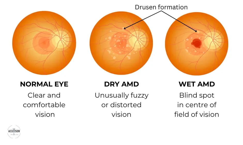 Age-related macular degeneration diagram of drusen formation on dry AMD vs wet AMD