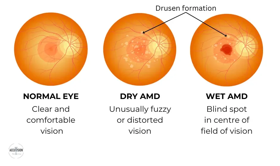 The Amsler Grid For Macular Degeneration - Millennium Eye Center