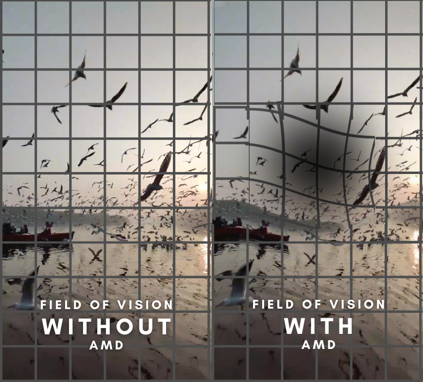 Field of vision before vs after age-related macular degeneration — comparison image.