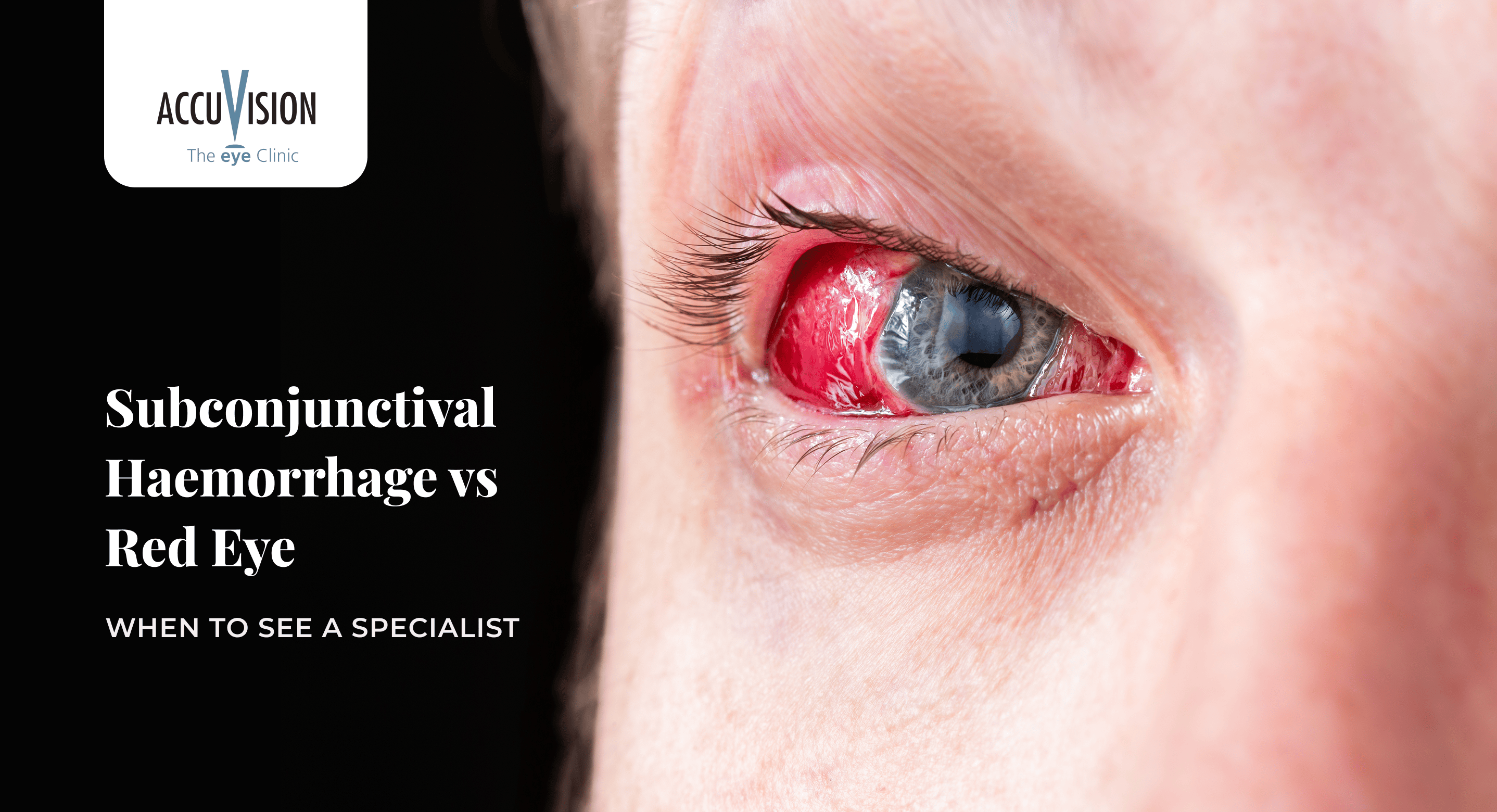 Subconjunctival haemorrhage versus red eye appearance explained