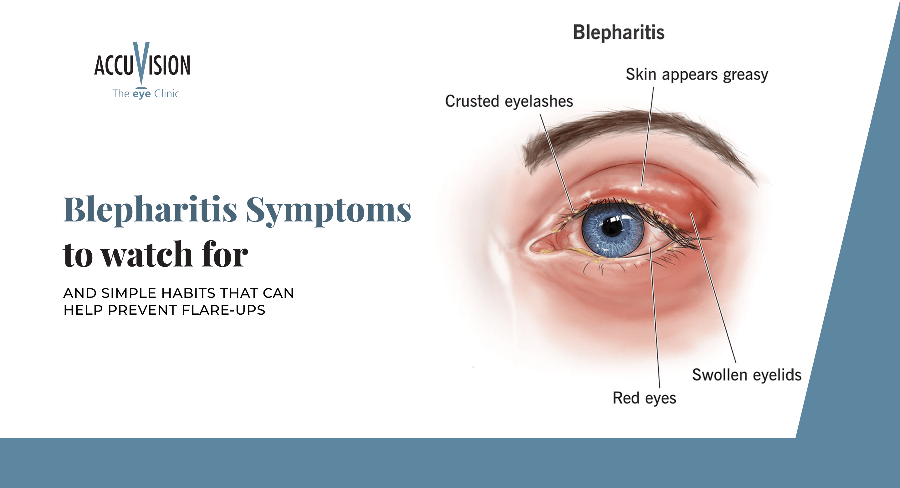 Blepharitis Symptoms to Watch For and Simple Habits That Can Help Prevent Flare-Ups