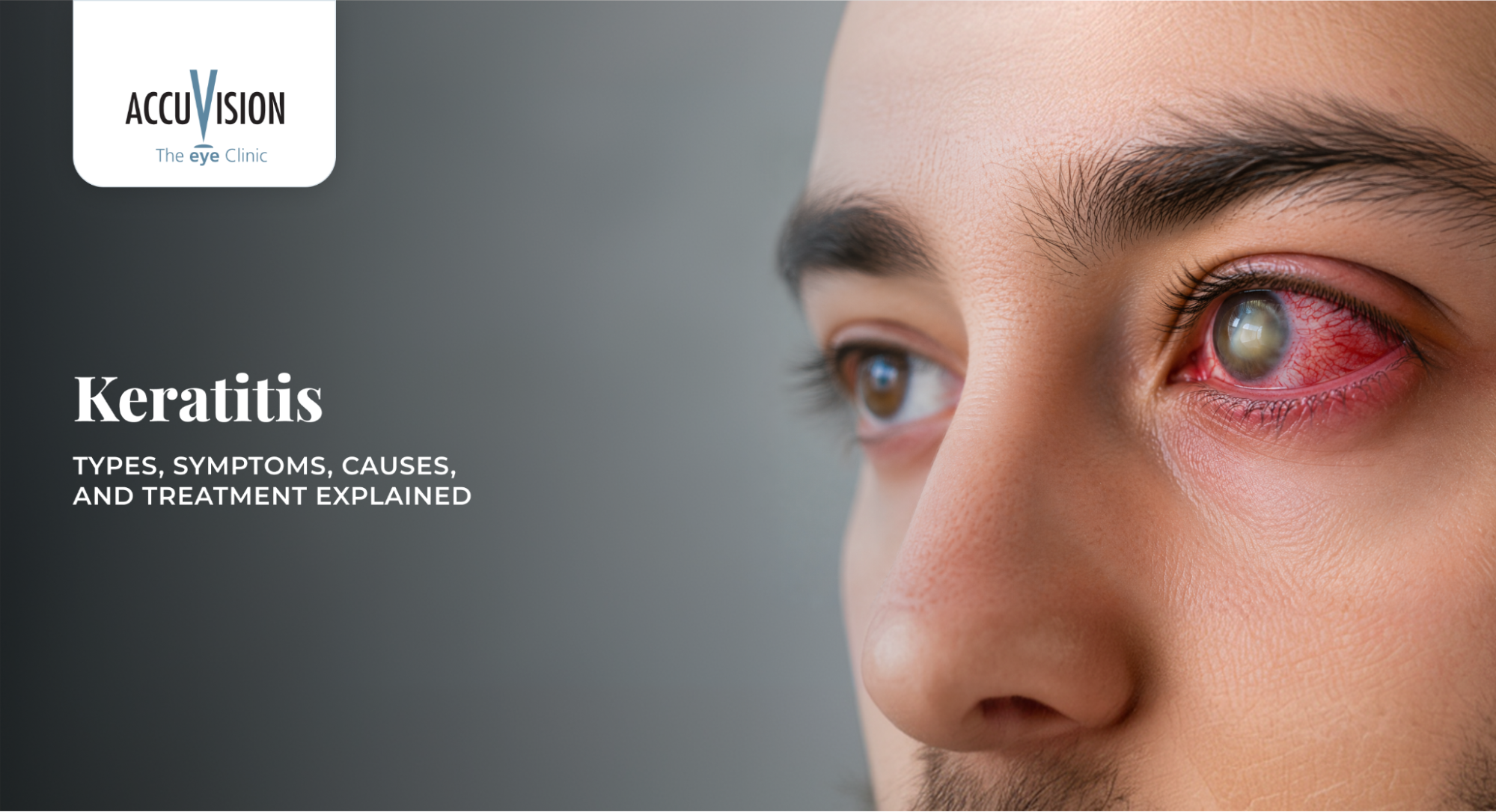 Keratitis: Types, Symptoms, Causes, and Treatment Explained