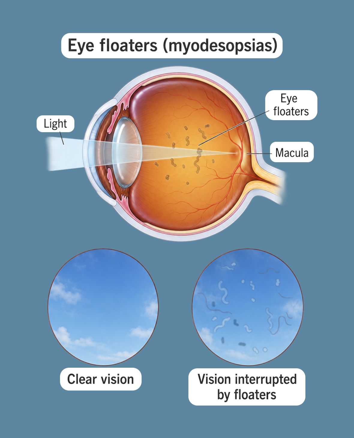 Eye Floaters