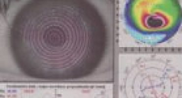 Keratoconus – a new option for patients